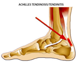 orthotics for achilles tendinopathy